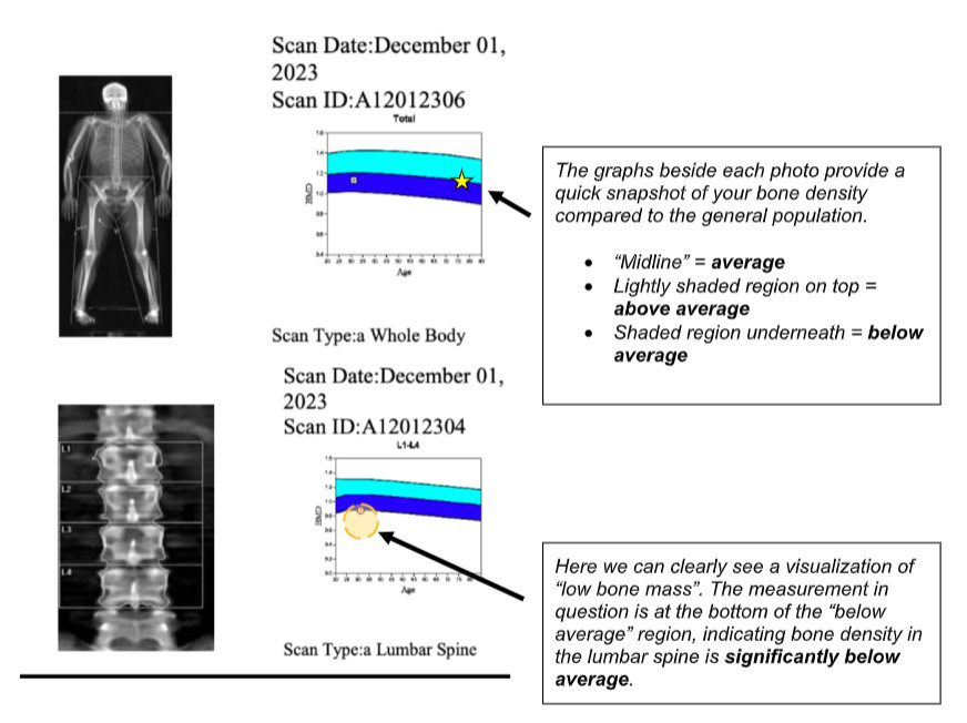 DEXA bone density scan report layout visualization showing spine and hip bone mineral density charts